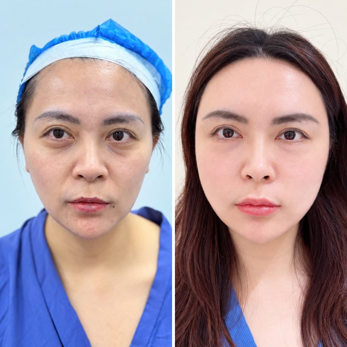 Cosmetic treatment result shown before and after recovery