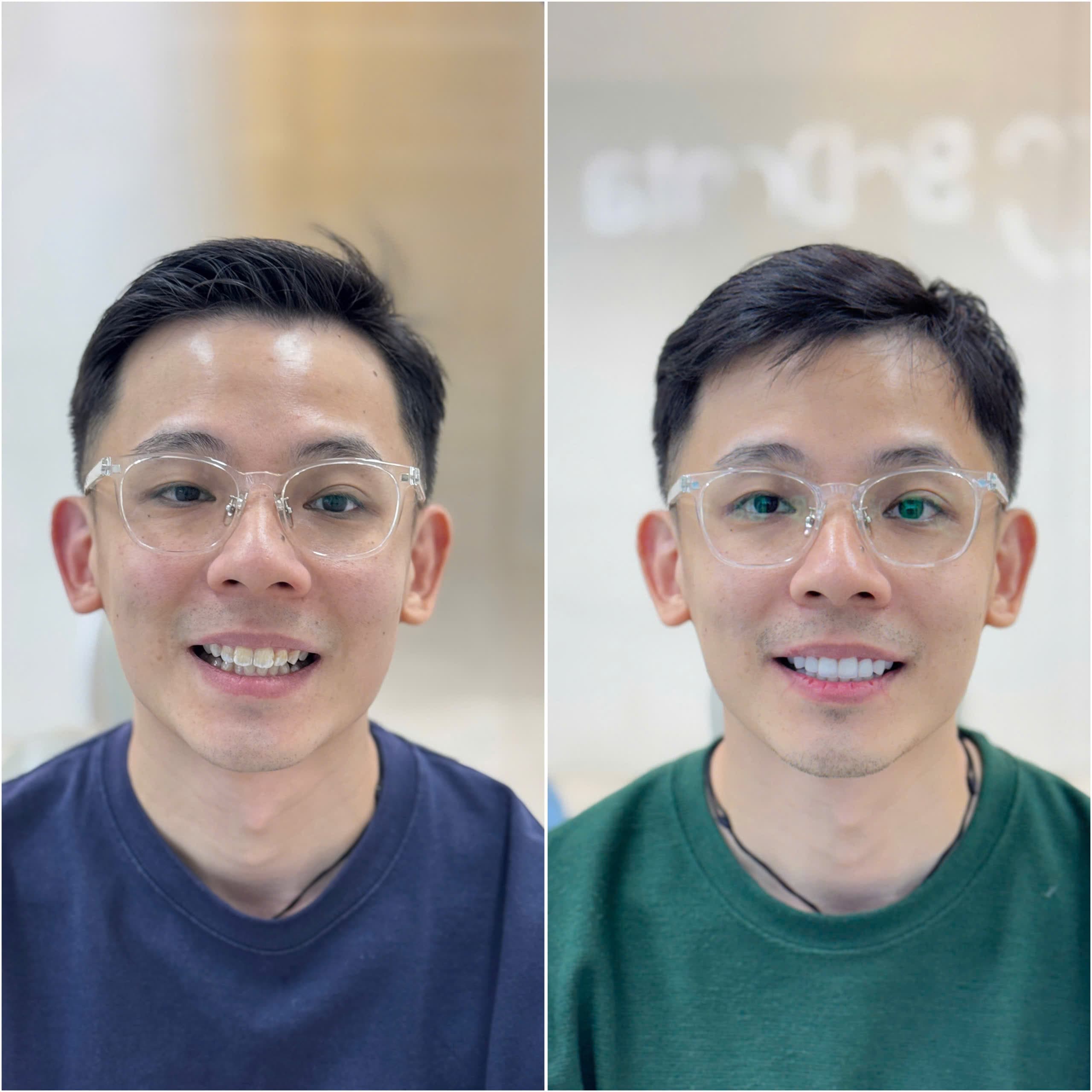 Dental patient before and after treatment