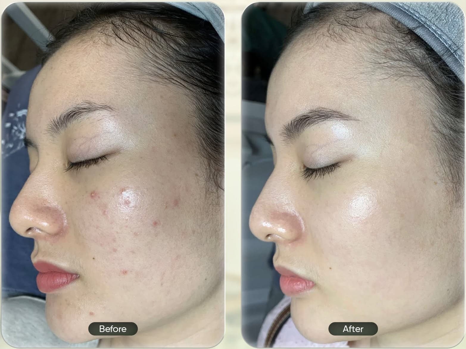 Acne treatment result shown before and after care