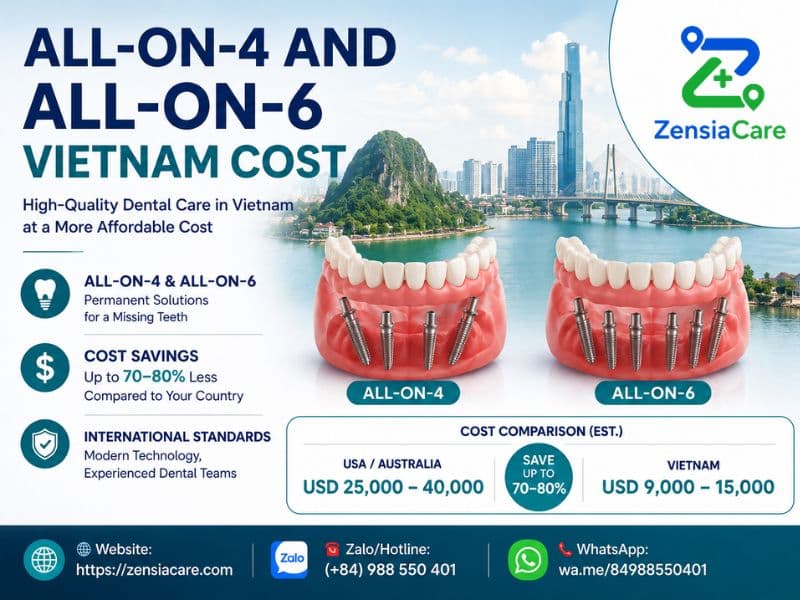All-on-4 and All-on-6 Vietnam cost and dental treatment options