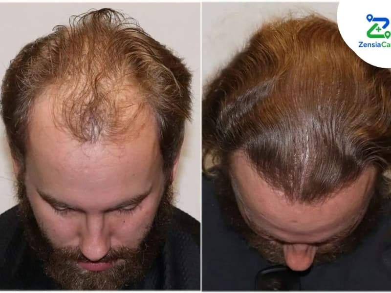 FUE Hair Transplant Before and After in Vietnam
