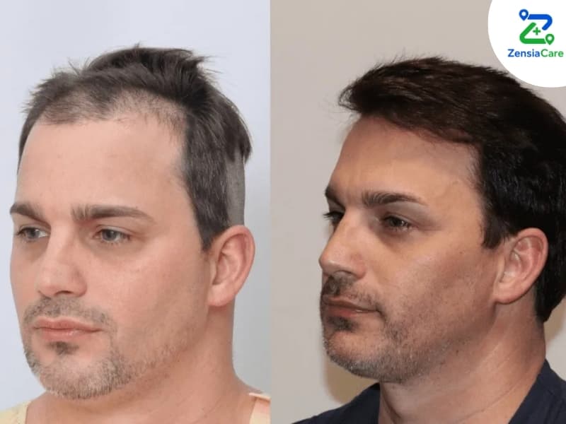 DHI Hair Transplant Before and After in Vietnam