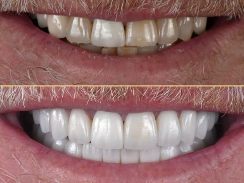 Full mouth restoration in Vietnam best price