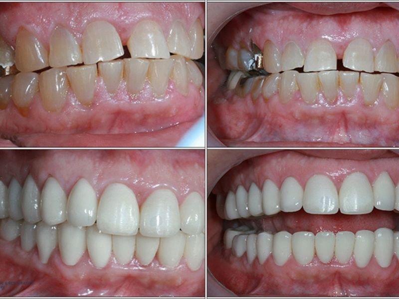 Full mouth restoration in Vietnam