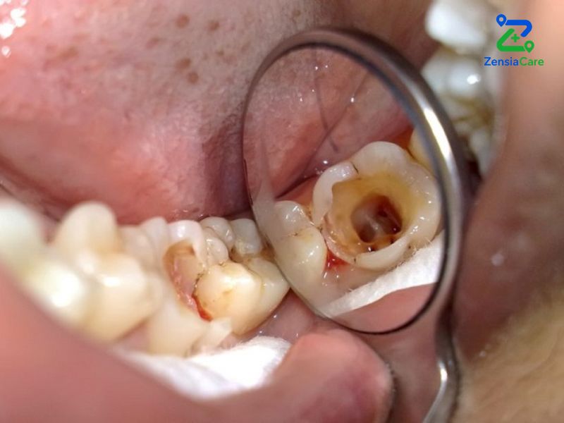 Zirconia Crowns and Bridges in Vietnam cost and guide