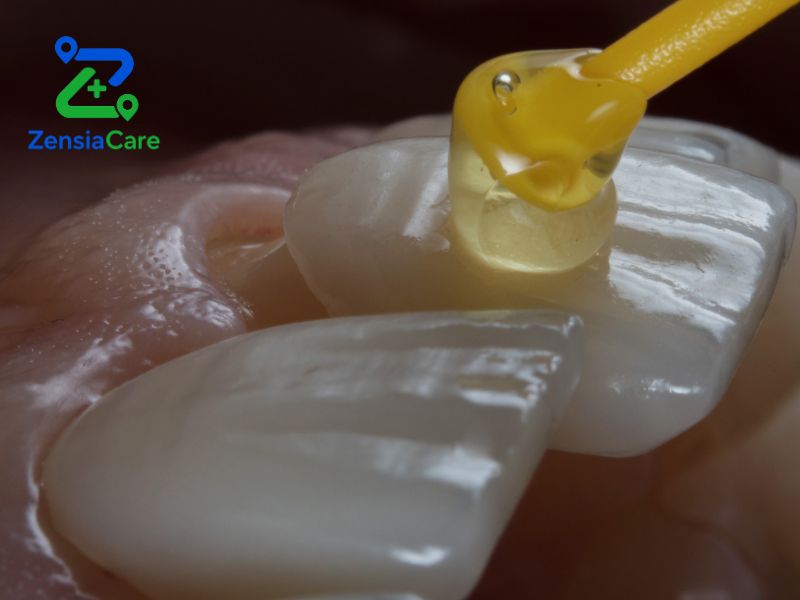 Porcelain veneer treatment in Vietnam