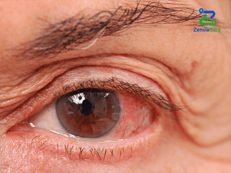 Elevated Eye Pressure After ICL Surgery