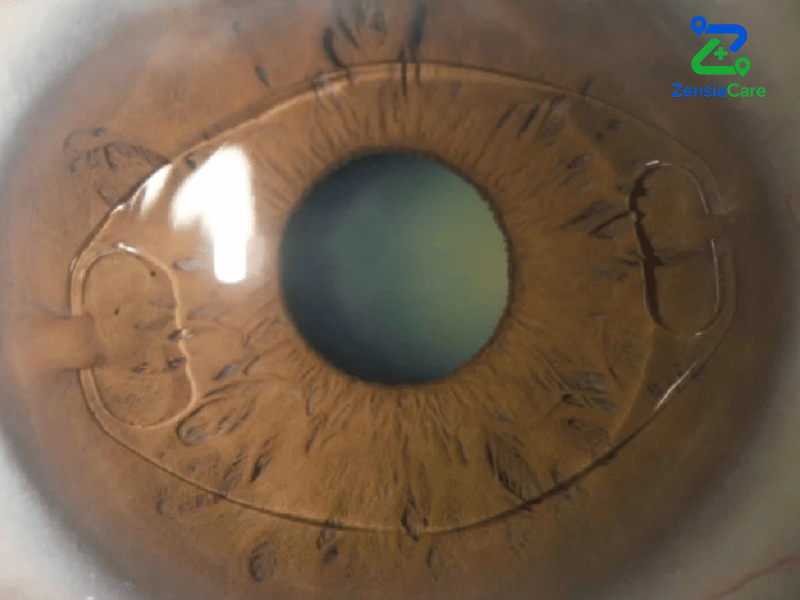 ICL surgery in Vietnam
