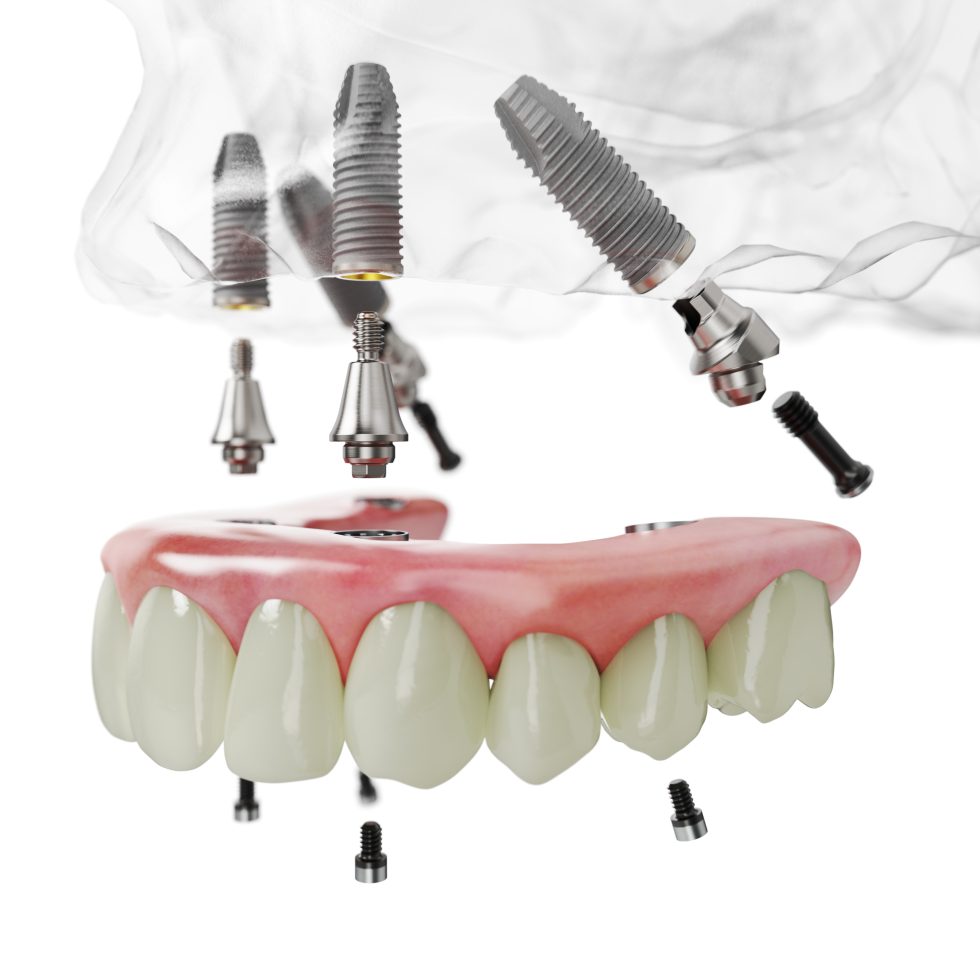 All-on-4 method for international patients