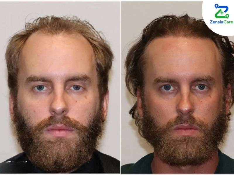 FUE hair transplant showing improved frontal hair coverage