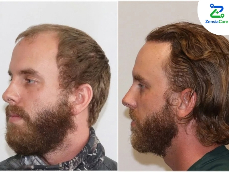 FUE Hair Transplant Process and Recovery