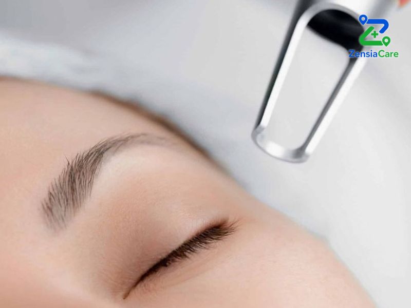Pico laser treatment